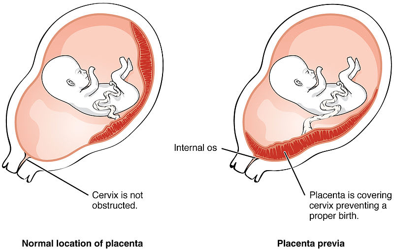 placenta previa as abortion complications